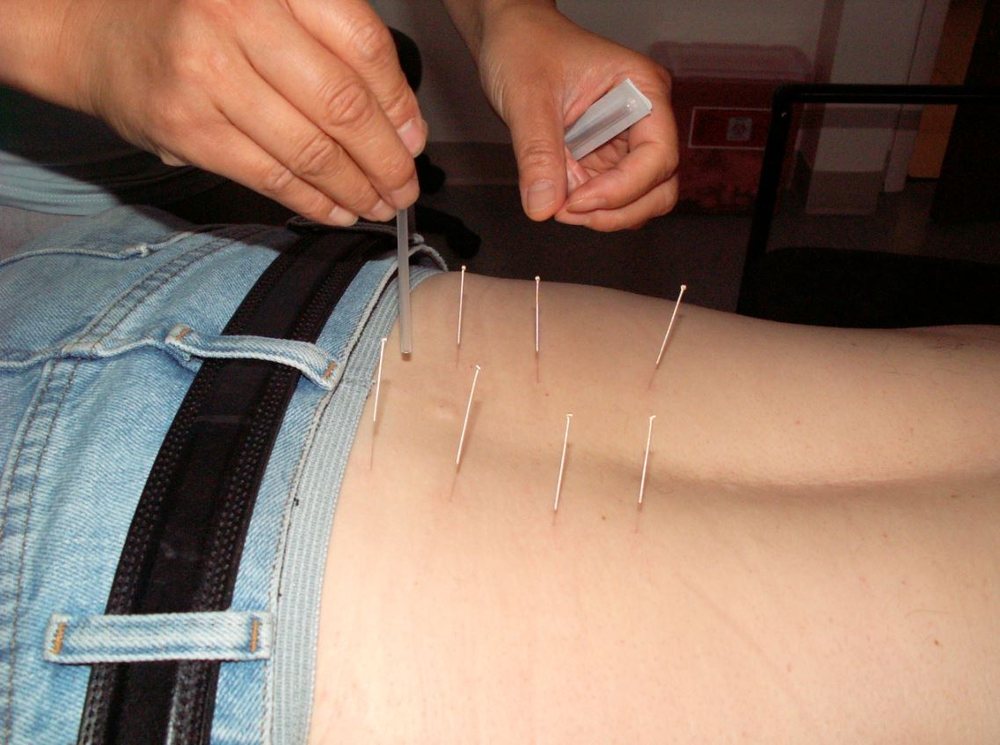 Al shifa Acupuncture Hijama Thurakkal Kondotty