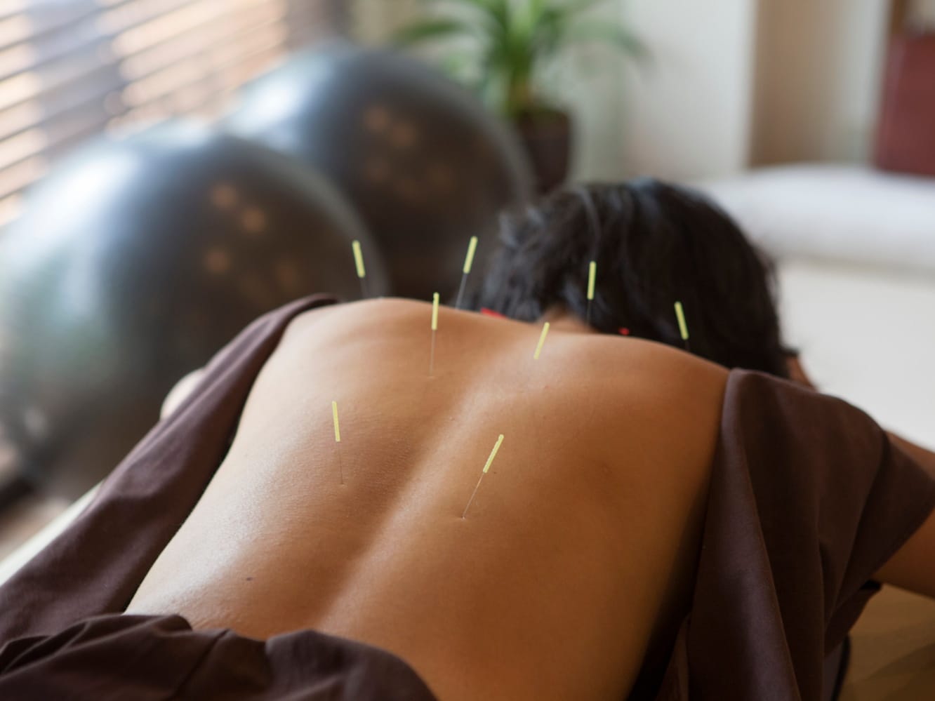 Al shifa Acupuncture Hijama Thurakkal Kondotty